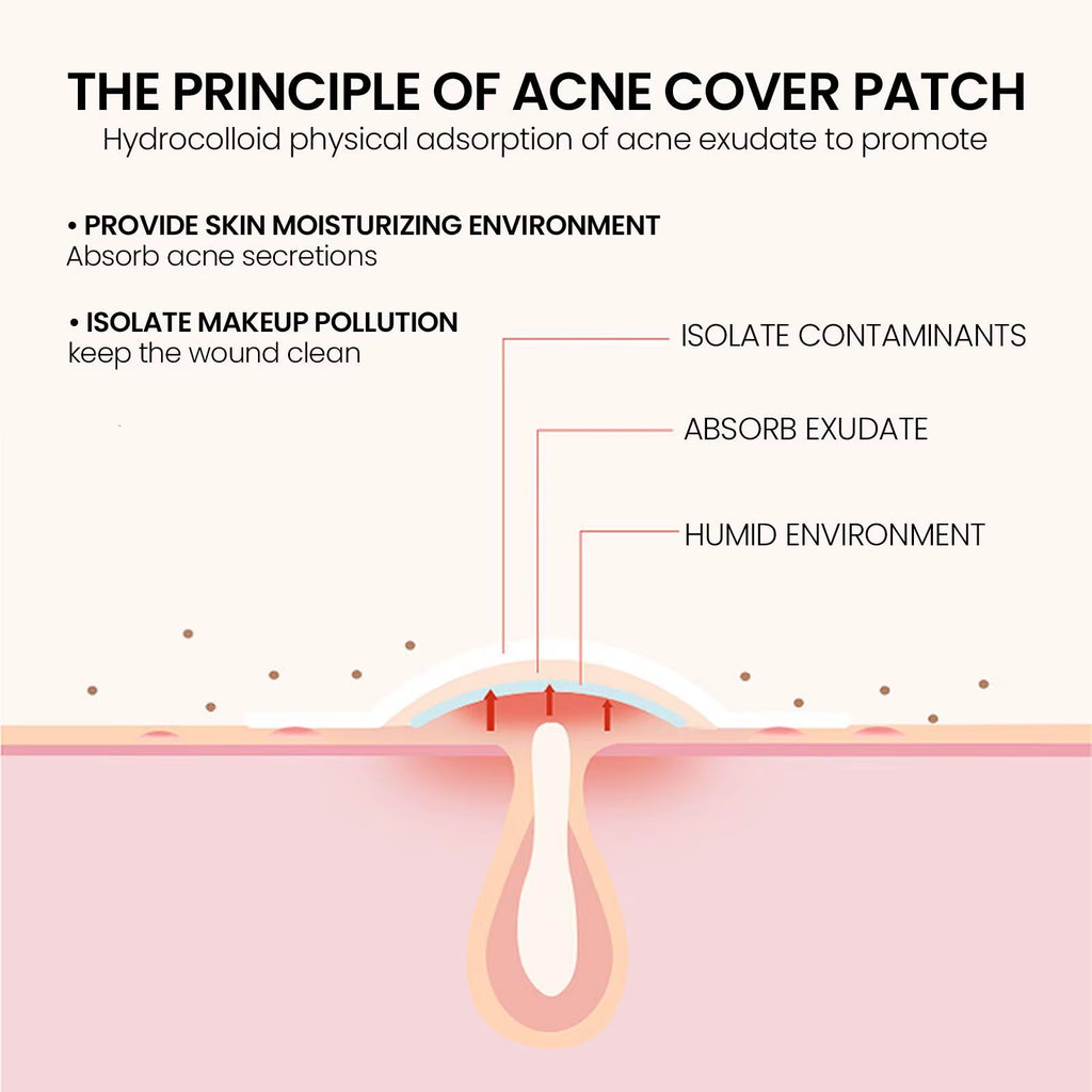 240 Pieces of Multi-Color Star Acne Patches, Facial Acne Patches, Concealer Acne Patches, and Pimples Patches, Ultra-Thin